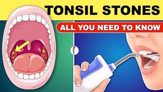 Tonsil Stones | Tonsil Stones Treatment | Tonsil Stone Removal - All You Need to Know