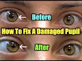 How to fix a damaged pupil. Iris repair to fix a damaged pupil - Pupilloplasty.