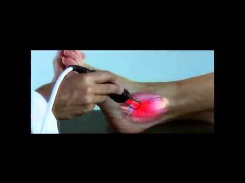 Artroza medicamentelor pentru durerea articulațiilor la genunchi