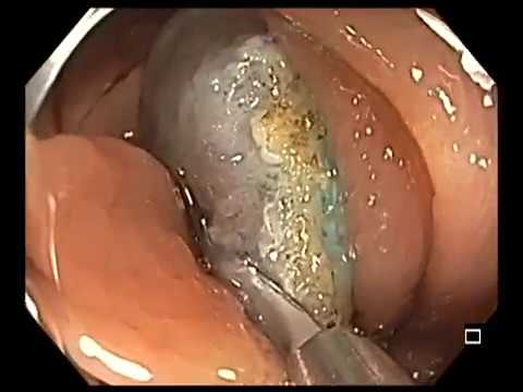 Extirpación de un pólipo de colon transverso