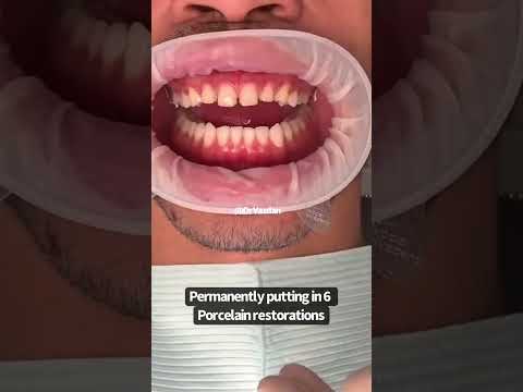 Porcelain veneers procedure | porcelain veneers before and after | cosmetic dentist | Dr. Yazdan