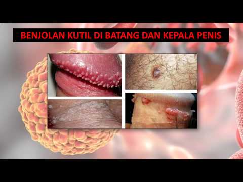 tratamentul prick vision
