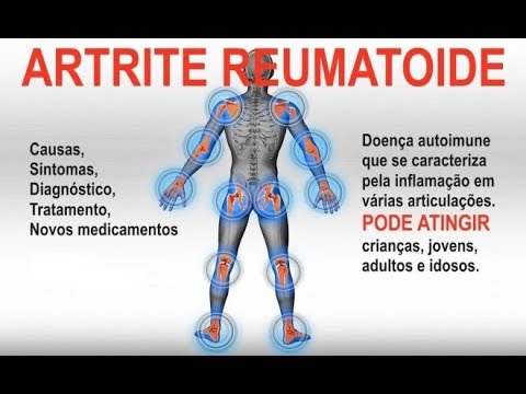 Artroza tratamentul artritei g
