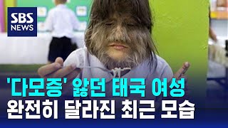 '다모증' 앓던 태국 여성, 완전히 달라진 최근 모습 공개 / SBS / 오클릭