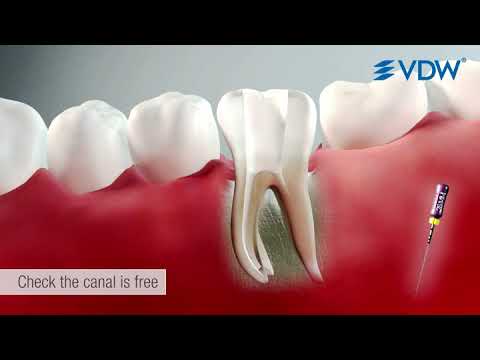 VDW Dental · How To: Root canal preparation with RECIPROC blue R25