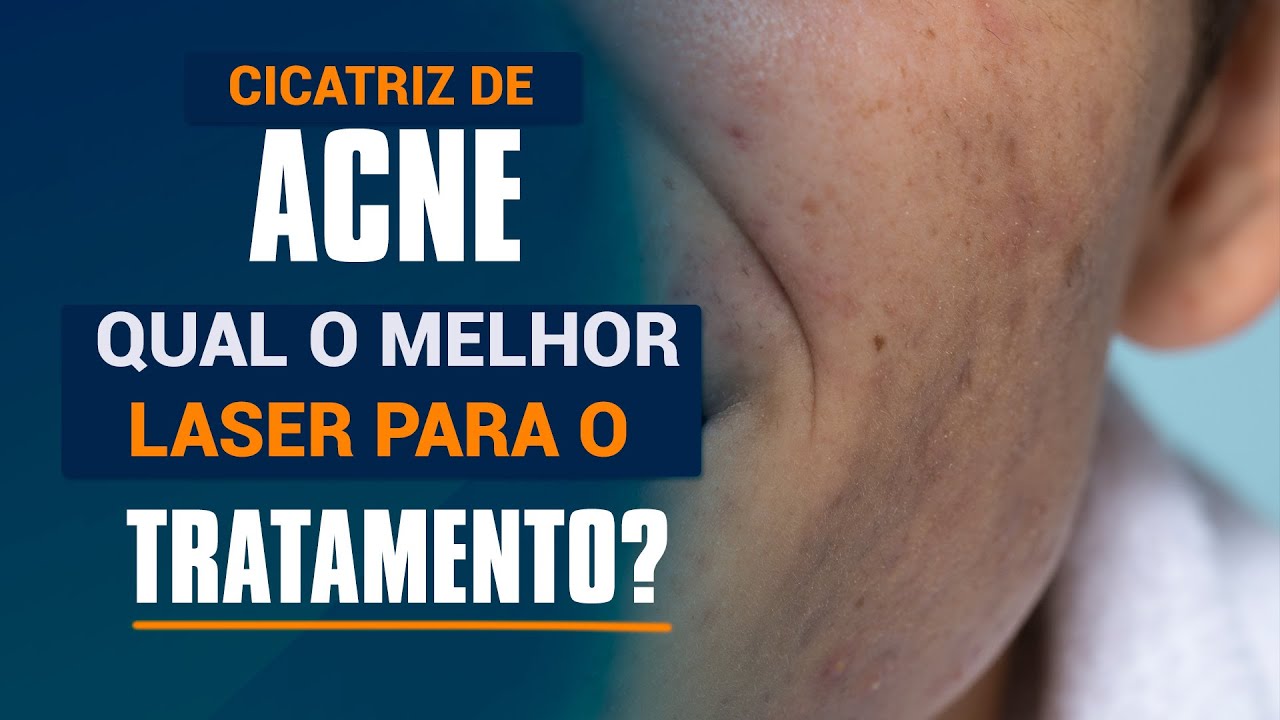Cicatrizes de Acne - Qual o melhor laser para o tratamento
