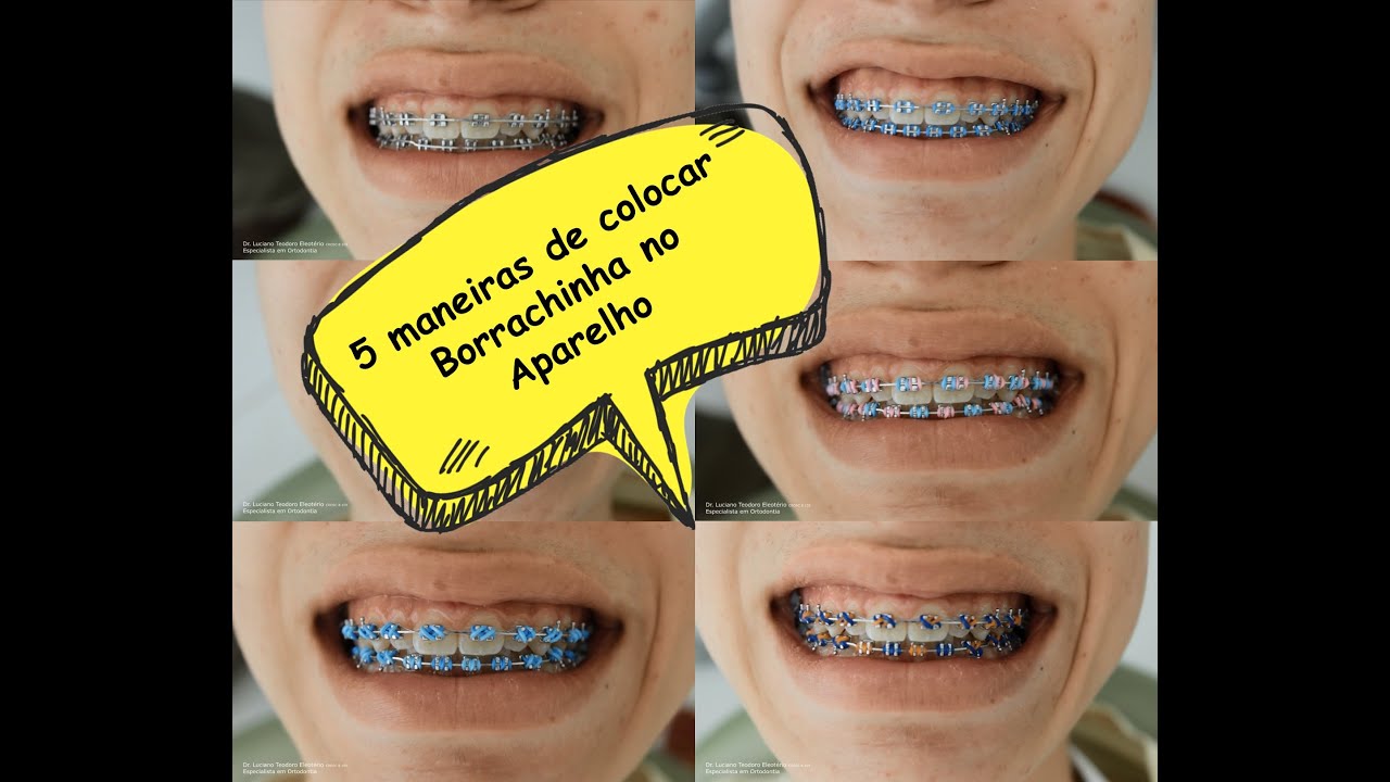 Watch Now 5 Maneiras de Colocar Borrachinha no Aparelho 5 Maneiras de Colocar Borrachinha no Aparelho