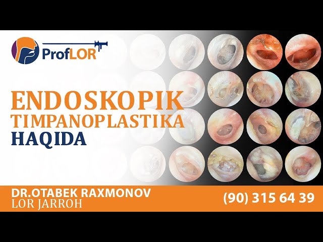 Endoskopik Timpanoplastika eng zamonaviy usulda quloq pardasini yamash operatsiyasi haqida