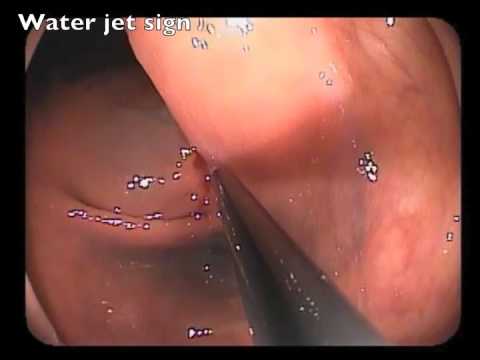 Water Jet Sign - A Sign of Submucosal Invasion