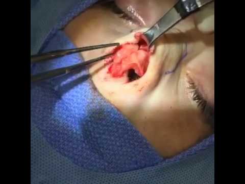 Open rhinoplasty 9