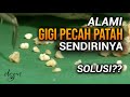 Mengatasi Gigi Pecah Sendirinya