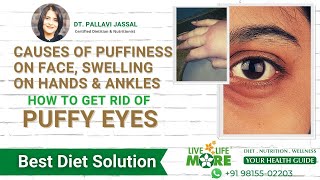 Causes of Puffiness on Face, Swelling on Hands & Ankles -How to Get Rid of Puffy Eyes |100% Solution