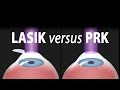 LASIK or PRK? Which is right for me? Animation.