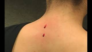 Blood Letting on the Upper Back Tung Points by Henry McCann