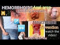 HEMORRHOIDS mayron kaba nito? [Tagolog/English Vlog] ano ang kakaibang lunas nito? #haemorrhoids