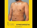 Before After Results For Gynecomastia Surgery Maleboobs Boobjob Shorts
