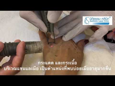 Vitaon จาก neurodermatitis ความพ่ายแพ้ของกระเพาะอาหารในโรคสะเก็ดเงินที่