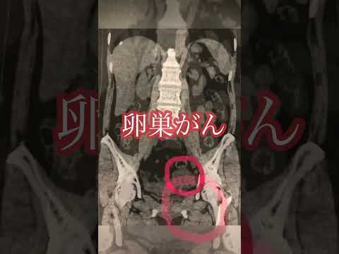 新しいがん治療の衝撃:致命的な腫瘍がわずか5日後に「ほぼ完全に」消失