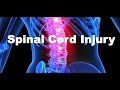 What is a spinal cord injury?