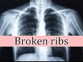 Broken ribs, symptoms and treatment