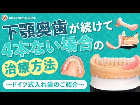 下顎奥歯が続けて4本ない場合の治療方法について〜ドイツ式入れ歯のご紹介〜