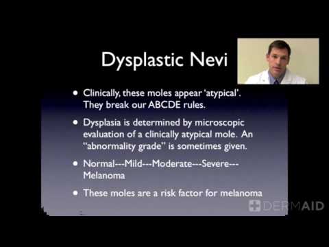 Atypical Nevi