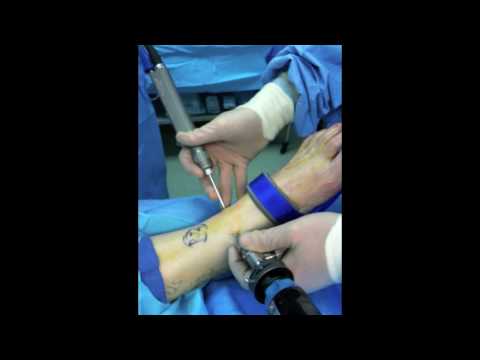 Ankle Arthroscopic Surgery