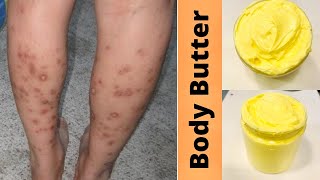 USE THIS DIY BUTTER TO GET RID OF DARK SPOTS ON LEGS & BODY FAST | GET CLEAR EVEN SKIN TONE ALL OVER