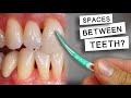 Do Floss Picks Cause Spaces Between the Teeth or Black Triangles?