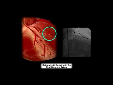 Botched Percutaneous Coronary Intervention