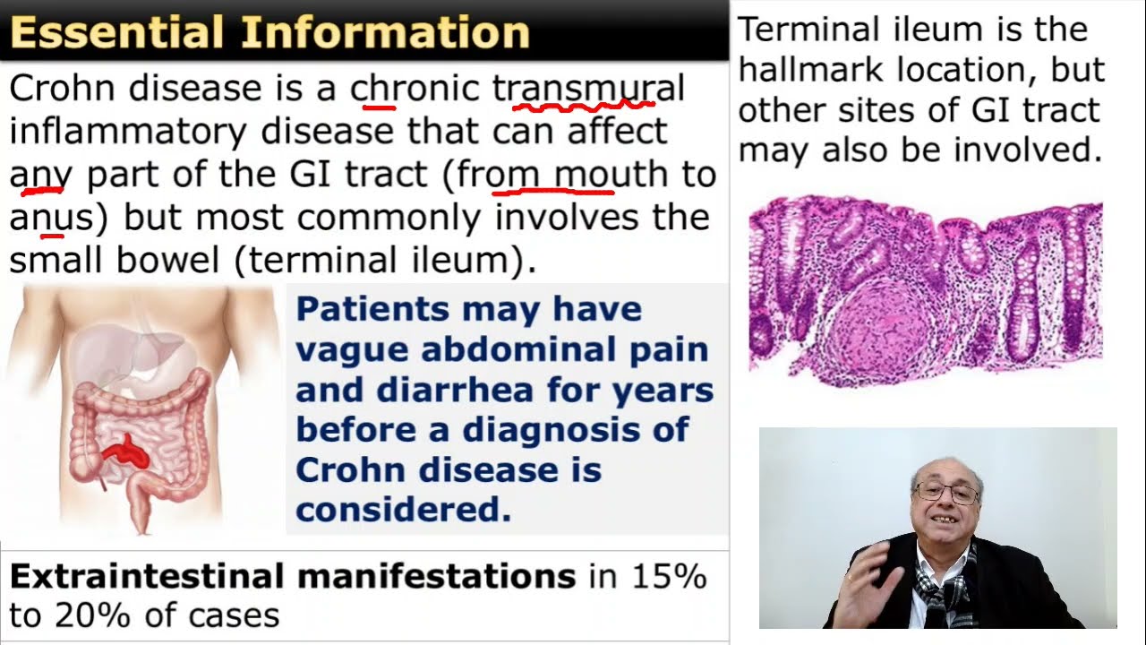Crohn Disease