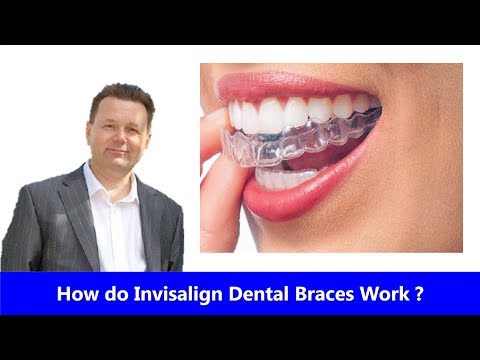 What and How do Invisalign braces work?