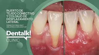 TRATAMIENTO de ENCÍAS RETRAÍDAS con COLGAJO desplazado lateralmente | Caso real de Clínica Pardiñas