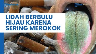JIJIK! Lidah Pria Asal Amerika Serikat Ini Ditumbuhi Bulu Berwarna Hijau, Gegara Sering Merokok