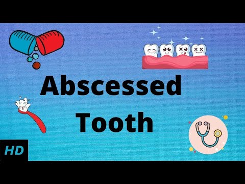Abscessed tooth, Causes, SIgns and Symptoms, Diagnosis and Treatment