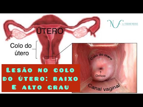 Cervical injury - low grade and high grade.