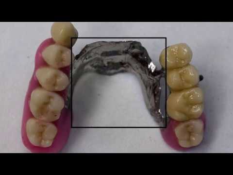 Teleskopprothese - einfach erklärt