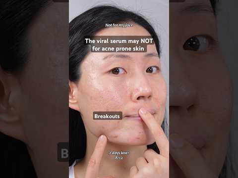 Is there any viral product giving you a breakout❓Anua Niacinamide+TXA serum #acneproneskin #pimple