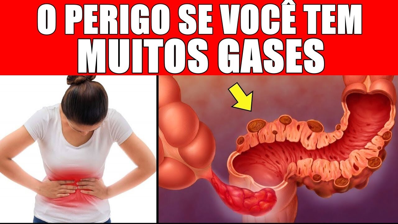 Alerta! Por Esta Razão Perigosa você tem MUITOS GASES, e ninguém te conta