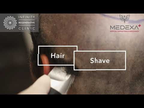 HAIR TRANSPLANT JOURNEY IN TURKEY - MA PLUS