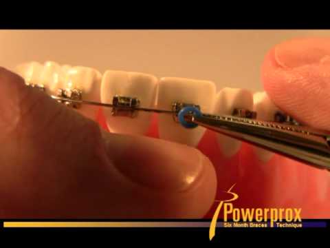 How to Tie an O-Ring Elastic Powerprox Six Month Braces Orthodontic Education Video