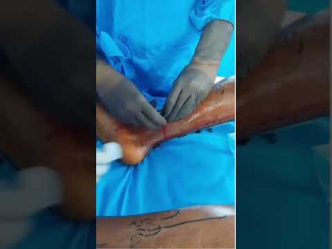 Laser Treatment for Varicose Veins | Endovenous Laser Ablation Explained | Dr. Abhilash V 