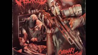Download lagu Aborted- Coronary Reconstruction EP mp3