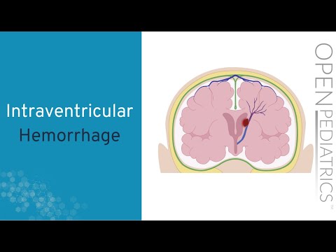 Intraventricular Hemorrhage by A. Hansen | OPENPediatrics