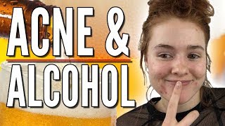 Alcohol and Liquor is Bad for your Skin and CAN Cause Acne!