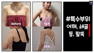 [360도 상체 지방흡입] 뼈팔뚝과 직각어깨, 슬림라인