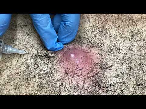 Removal of infected cyst from chest