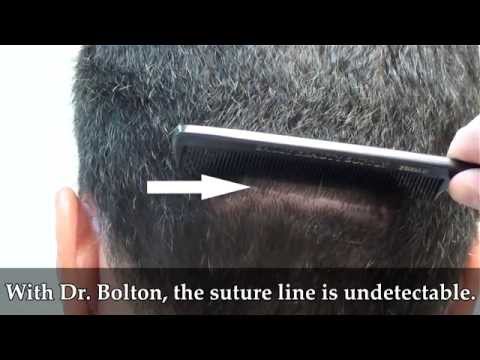 Jay's Undetectable Scar: 7mo