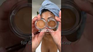 Download lagu THEEE ONE CONCEALER FOR ACNE OR DARK SPOTS‼️🤎 I use shade caramel mp3 Download lagu THEEE ONE CONCEALER FOR ACNE OR DARK SPOTS‼️🤎 I use shade caramel mp3