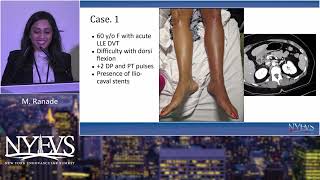 AngioJet DVT NY Endovascular